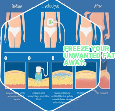 Body fat freezing