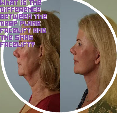 Deep plane neck lift