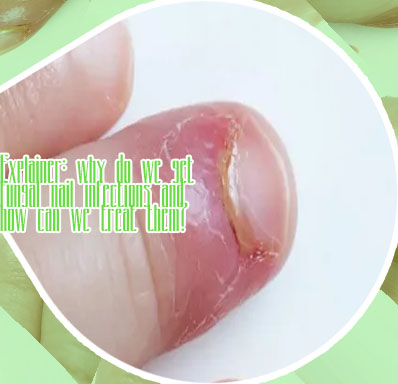 Infected cuticle treatment