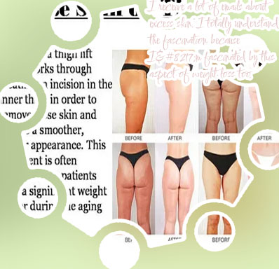 Loose skin on breast