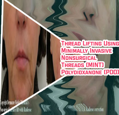 Non surgical jowl lift