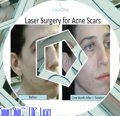 Smartskin co2 laser acne scars
