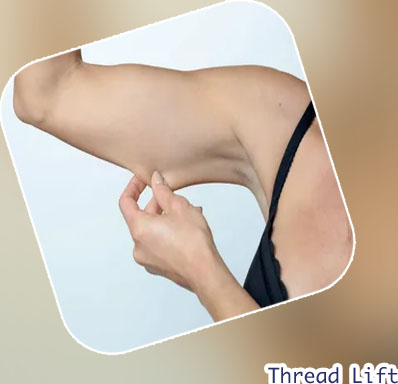 Thread arm lift
